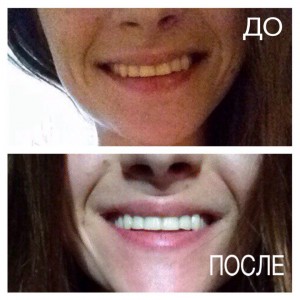 до и после чистки зубов