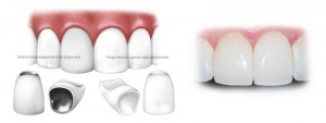 протезирование фронтального зубного ряда