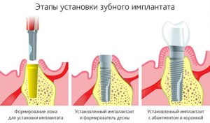 Этапы установки зубного импланта