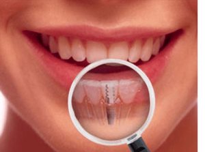 Имплантация зубов в стоматологии на Народной