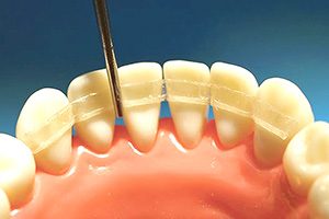 Протезирование или шинирование подвижных зубных единиц