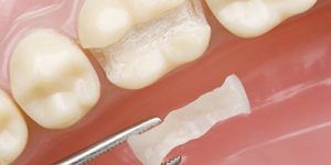 Восстановление зубов вкладками