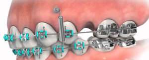 Мини-импланты в ортодонтии